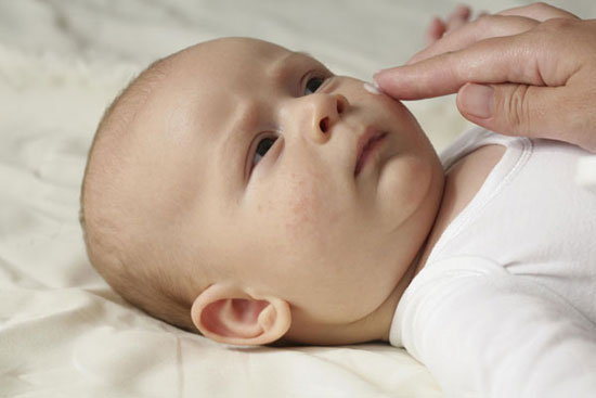 آیا آکنه های صورت نوزاد طبیعی است؟ + راه درمان